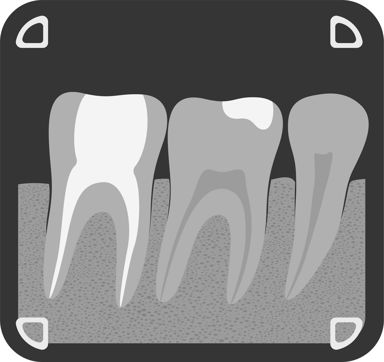 Tooth -ray illustration, Dental -ray